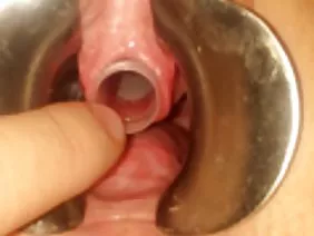 在一個白髮蒼蒼的小女孩身上，不僅緊身衣很破舊 - 她的撕裂的shmonka裝飾著十幾個穿孔，你可以輕鬆地將一整輛火車推到你的屁股上。在與男友進行了富有成效的會面之後，性交的花痴與她心愛的假陽具一起獨自留在了公寓裡。沒有潤滑劑的巨型假陽具進入泄殖腔，因此充滿信心地抽搐，好像他知道身體何時從興奮的痙攣中搖晃。如果正常的女性享受高潮，那麼這個異常的妓女更喜歡讓脫垂脫垂，並且離去的情人讓它去的精子從肛門孔溢出。警告：教皇的玫瑰可怕的景像不適合那些膽小的手淫者！